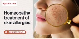 Homeopathy for allergies
