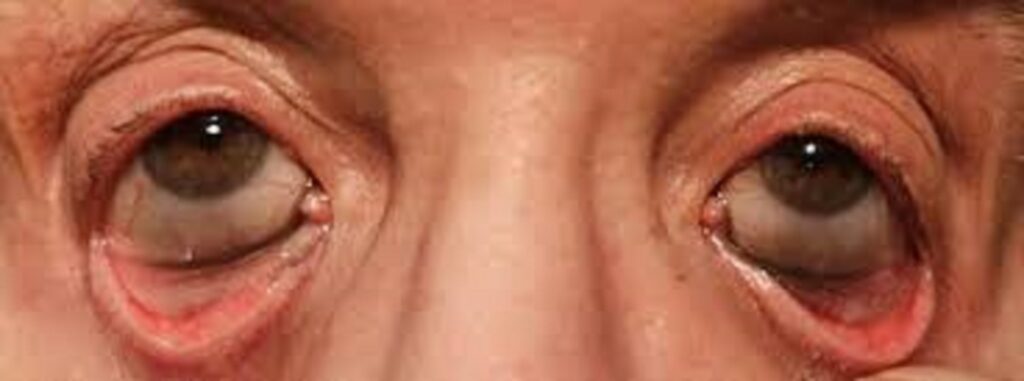 homeopathy eye drops