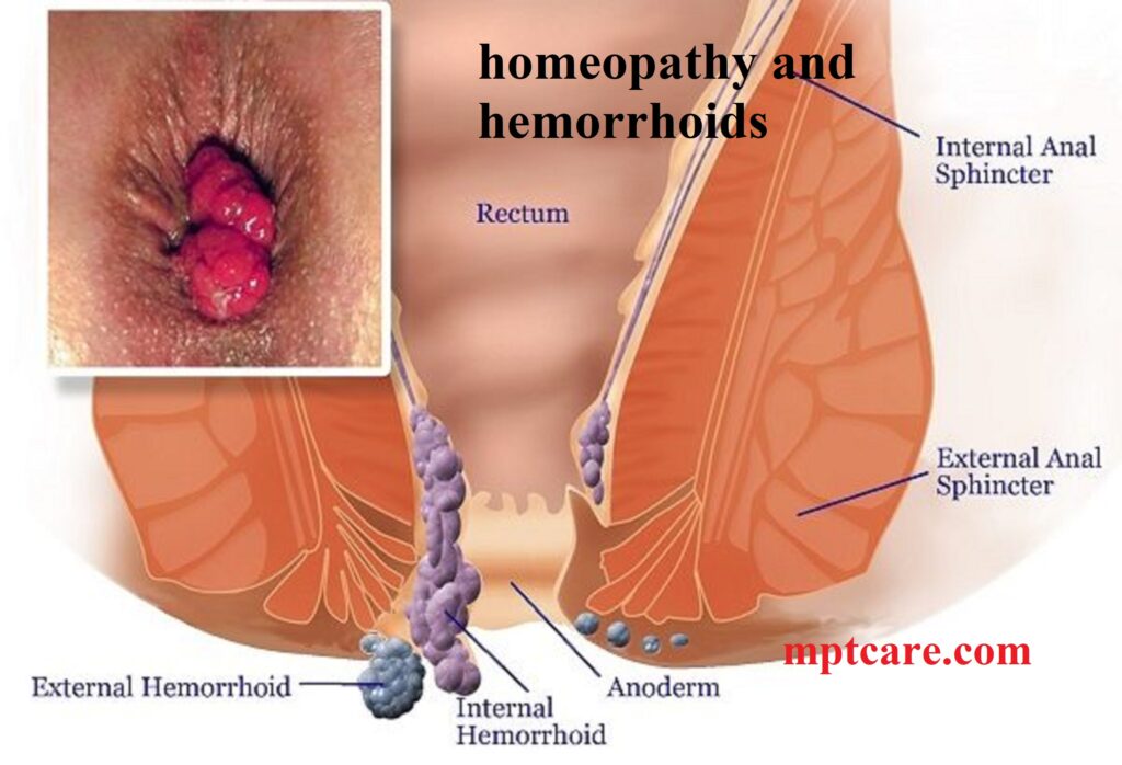 homeopathy and hemorrhoids