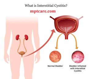 Homeopathy for urine infection