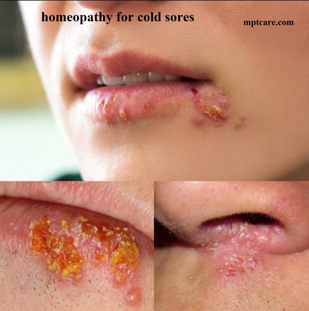 Homeopathy for Cold Sores