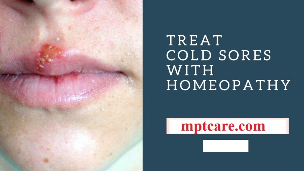 Homeopathy for Cold Sores