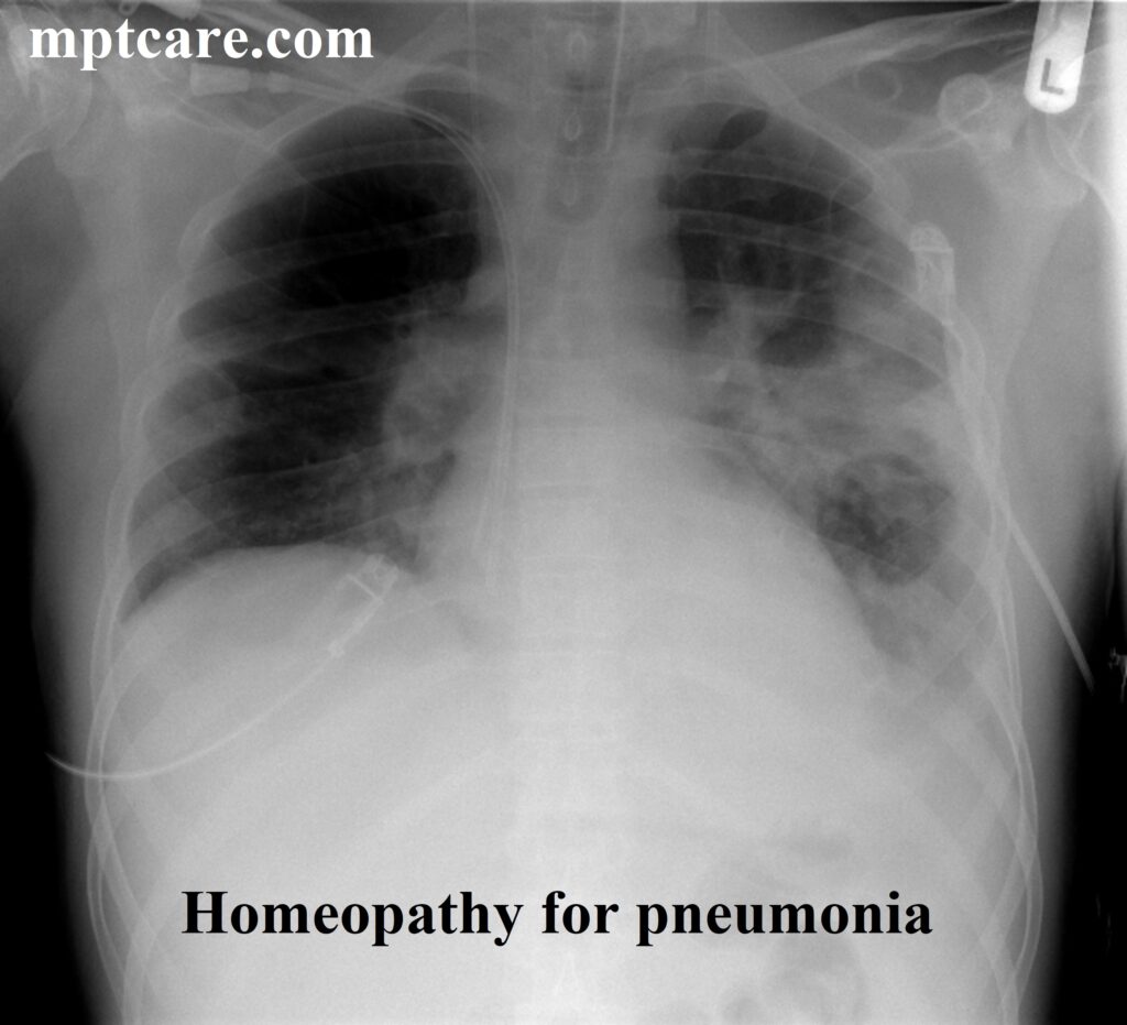 homeopathy for pneumonia