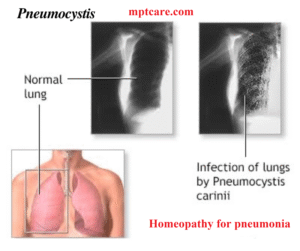 homeopathy for pneumonia