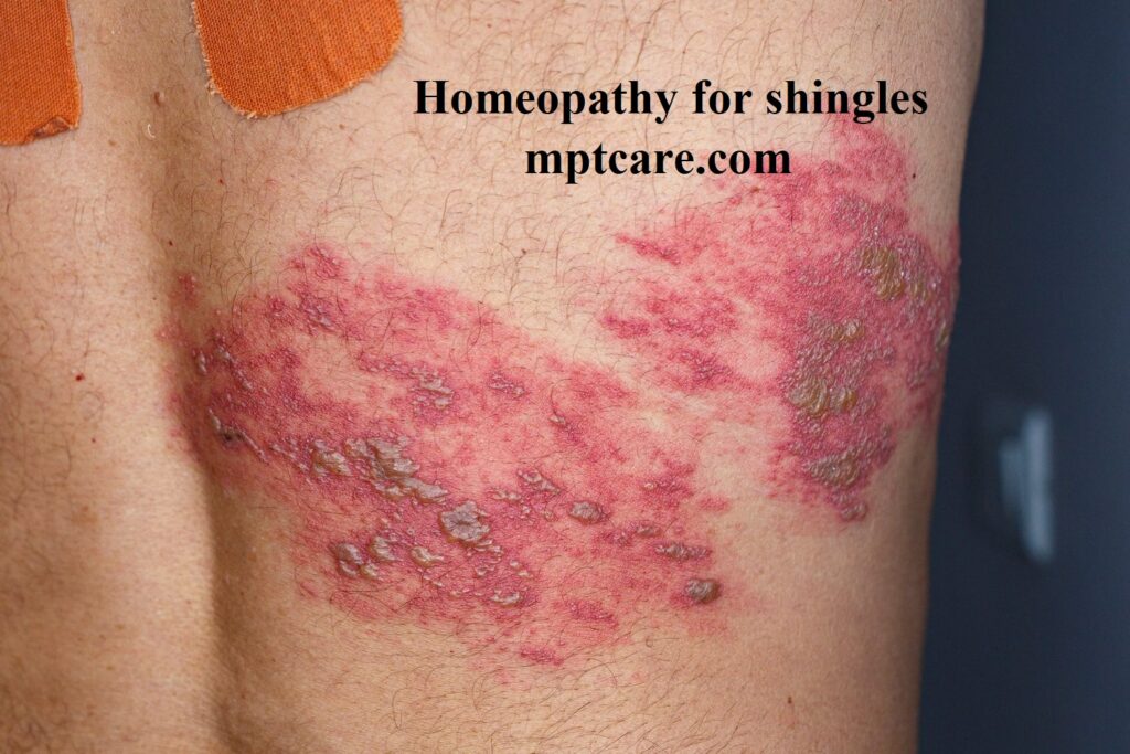 Sulphur Homeopathy