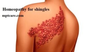 homeopathy for shingles