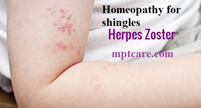 homeopathy for shingles