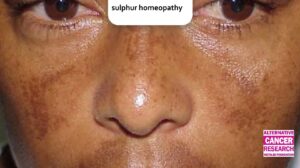 Sulphur Homeopathy