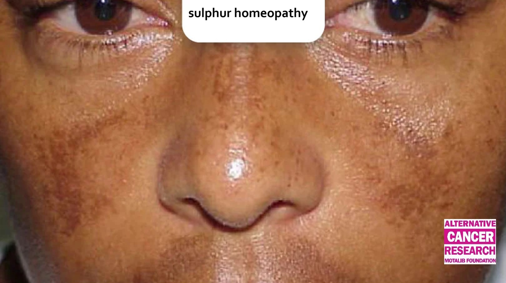 Sulphur Homeopathy