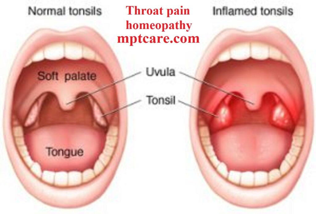 throat pain homeopathy care