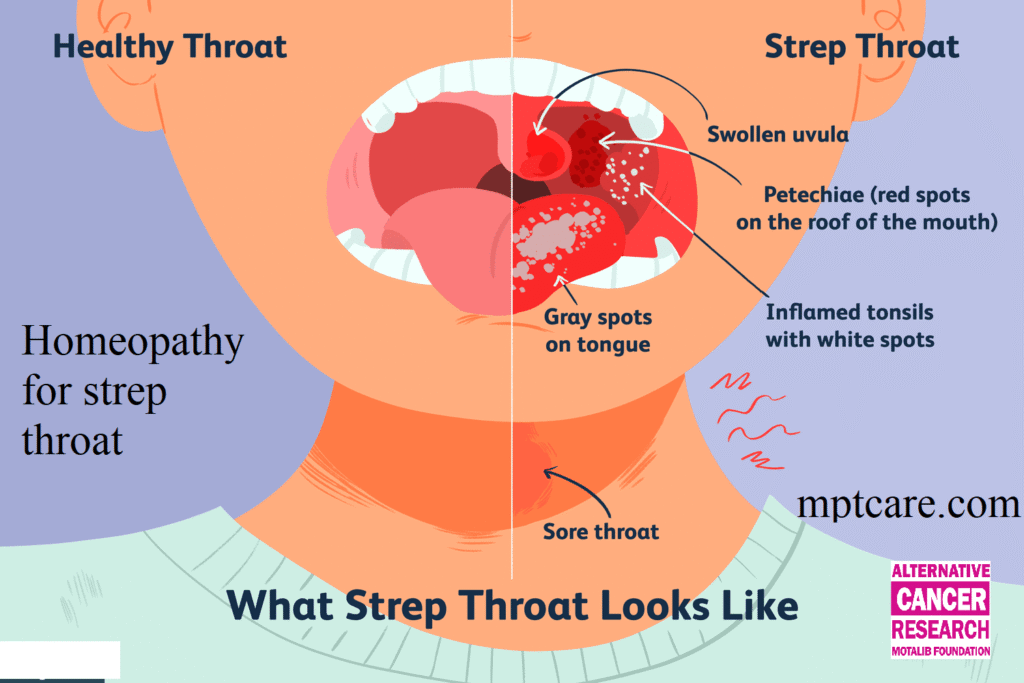 Homeopathy for strep throat