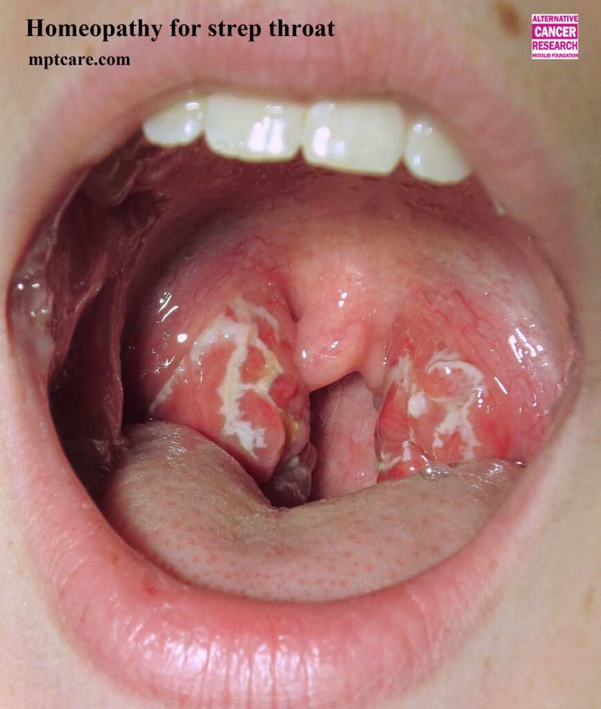 Homeopathy for strep throat