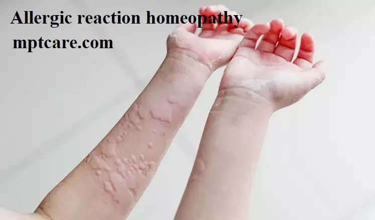 allergic reaction homeopathy