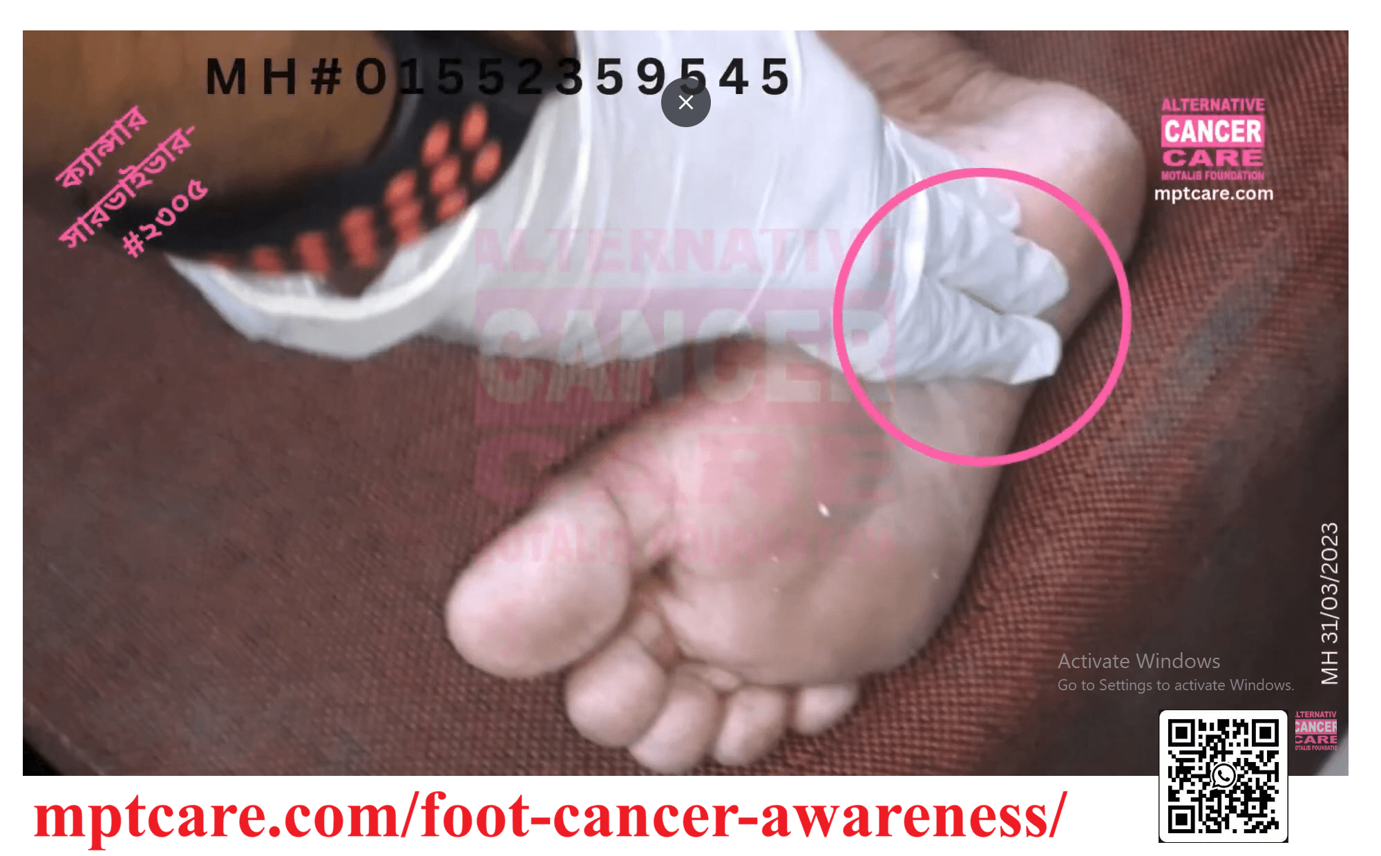 MPTCare Foot Cancer Awareness