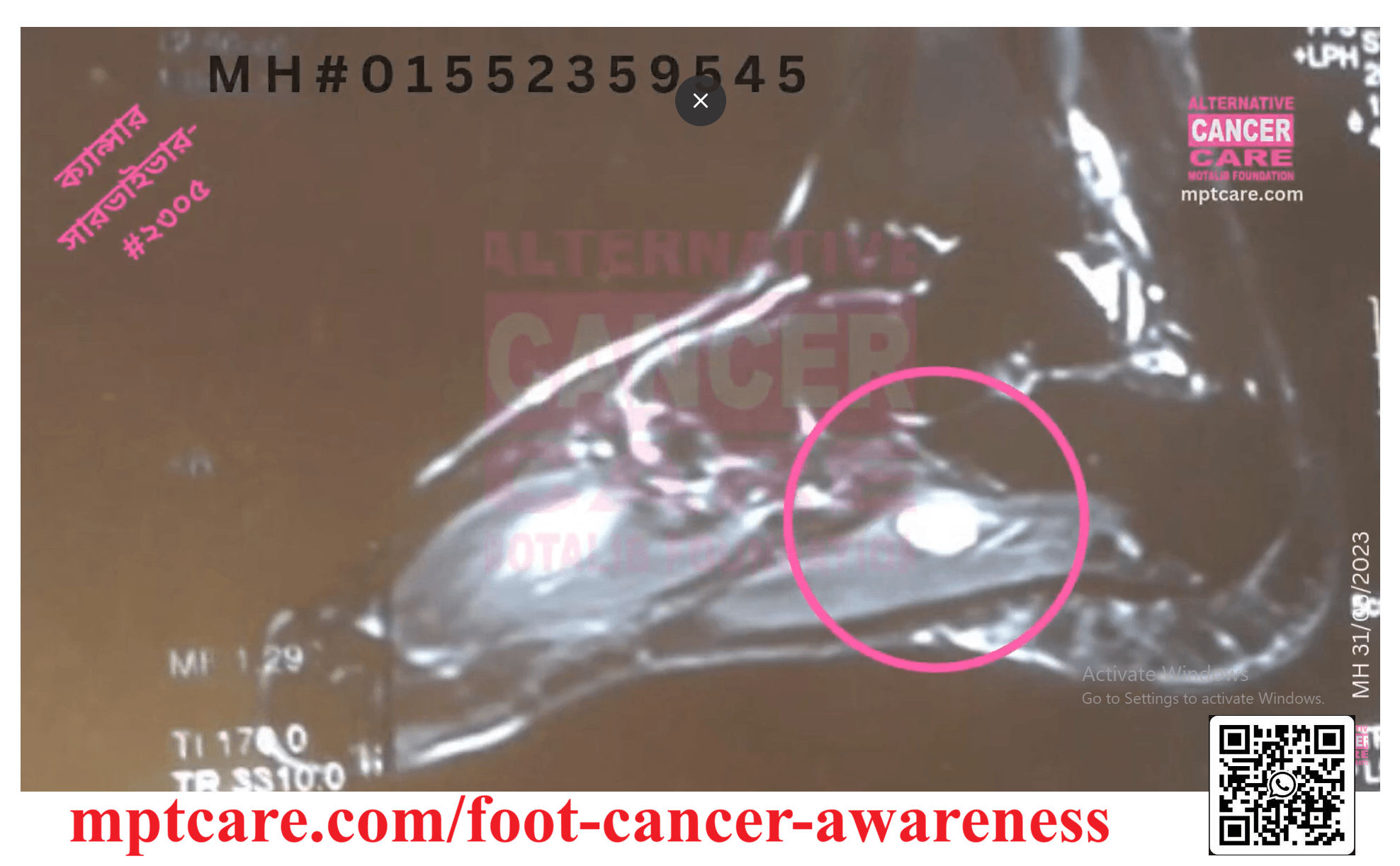 MPTCare Foot Cancer Awareness